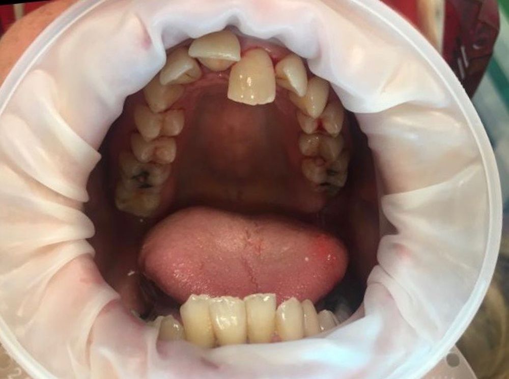 Linda 6 Month Braces Before